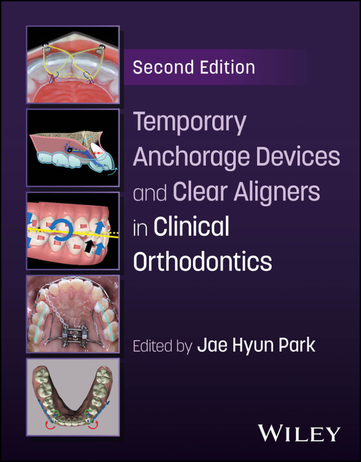 Temporary Anchorage Devices and Clear Aligners in Clinical Orthodontics